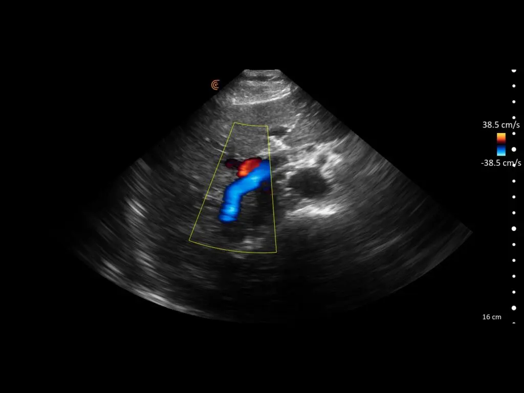 Transverse thoracic view of right lower lung lobe with pulmonary vessel visualized