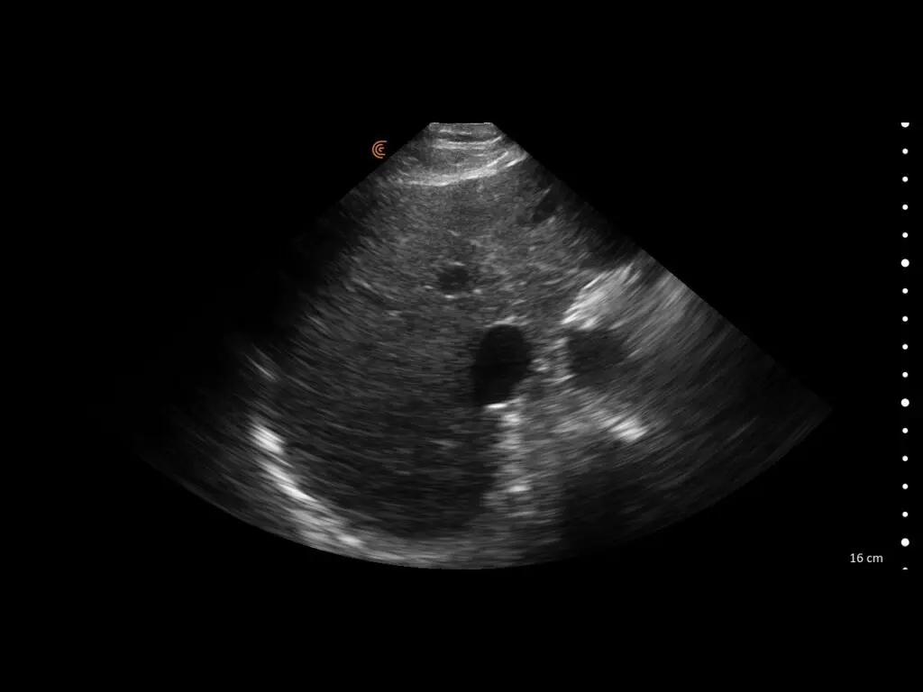 Transverse thoracic view of right lower lung lobe showing pleural line and lung tissue
