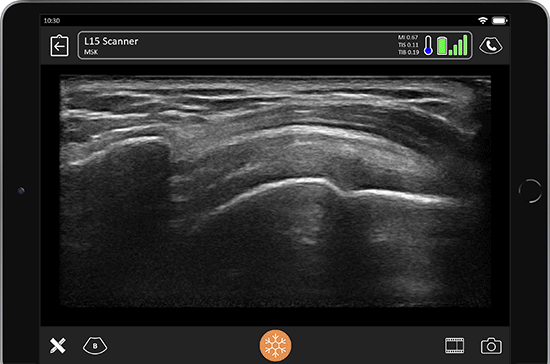 Mobile Clarius Ultrasound Image