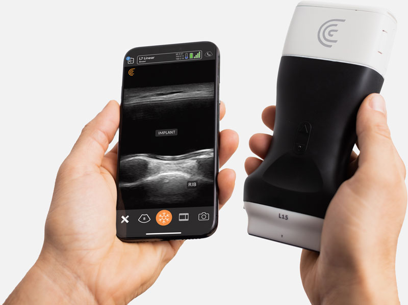 Ultrasound For Plastic Surgery Wireless Scanner Clarius Hd 8687