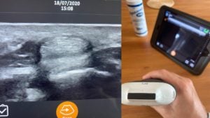 New Clarius Machines Take Image Quality of Handheld Ultrasound to the Next Level