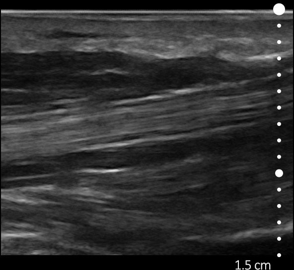 Sports Medicine Ultrasound Machine MSK & Podiatry Clarius HD