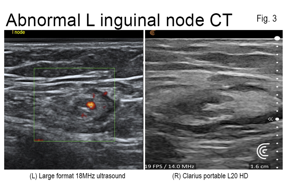 Point-of-Care Ultrasound Review of the Clarius L20 HD by Dr. Bard | Clarius