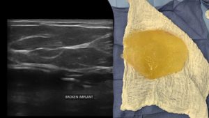 Handheld Ultrasound is Quick & Safe for the Surveillance of Silent Breast Implant Ruptures