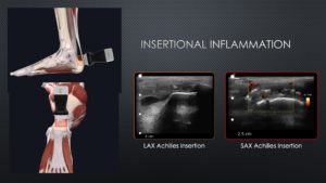 3 Physical Therapy Cases by Dr. Fritz- Handheld Ultrasound Takes Mechanical Diagnosis to the Next Level