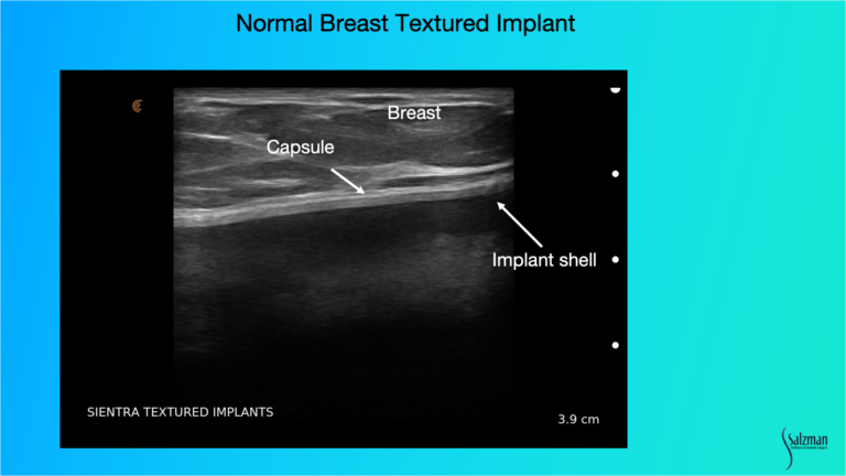 Handheld Ultrasound is Quick & Safe for the Surveillance of Silent