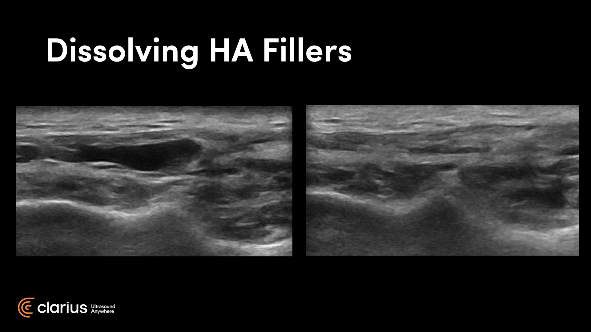 [VIDEO] Learn How to Use Ultrasound To Treat Dermal Filler