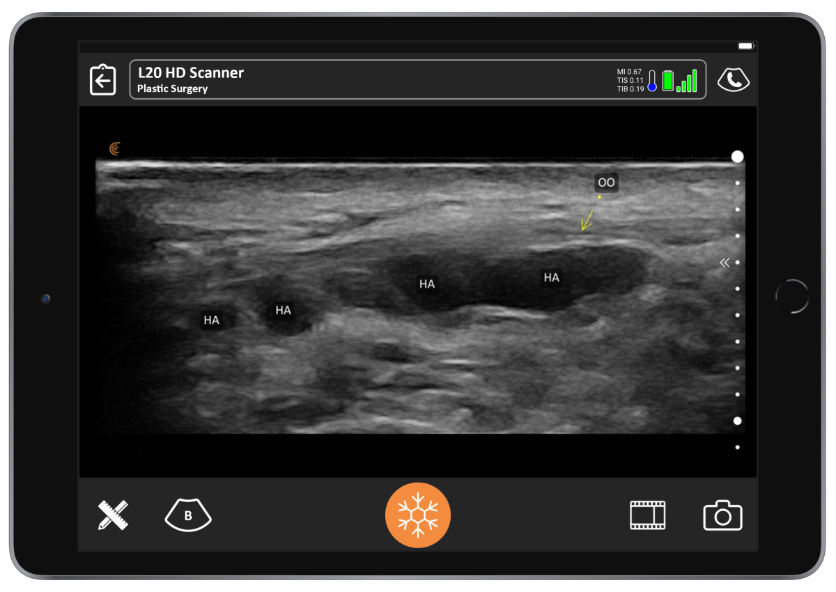 [VIDEO] Ultrasound in Facial Aesthetics Learn How to Evaluate & Dissolve Fillers Clarius