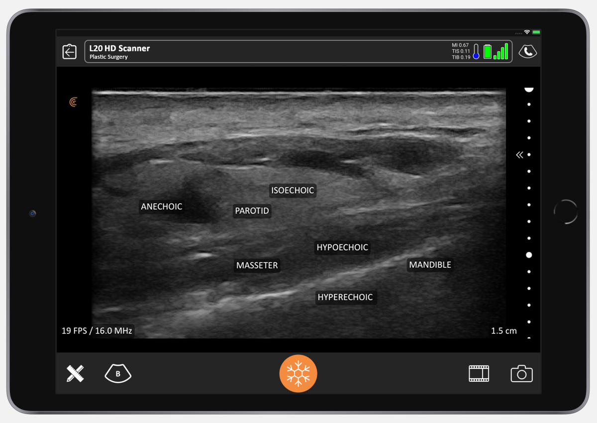 [VIDEO] Ultrasound in Facial Aesthetics Improving Filler Safety with Vascular Mapping Clarius