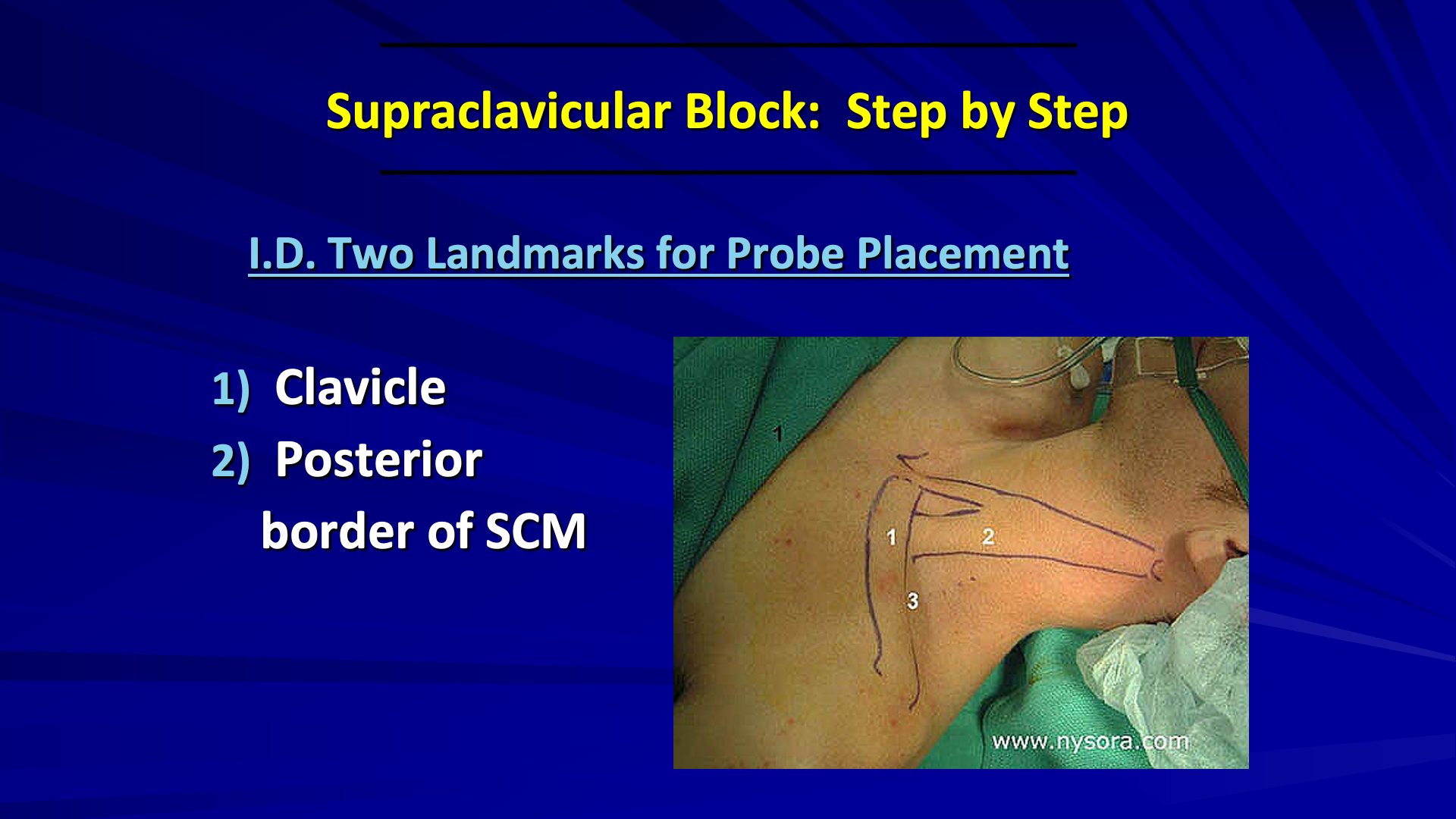 [VIDEO] Is the Supraclavicular Plexus Block the Right Choice to Prevent
