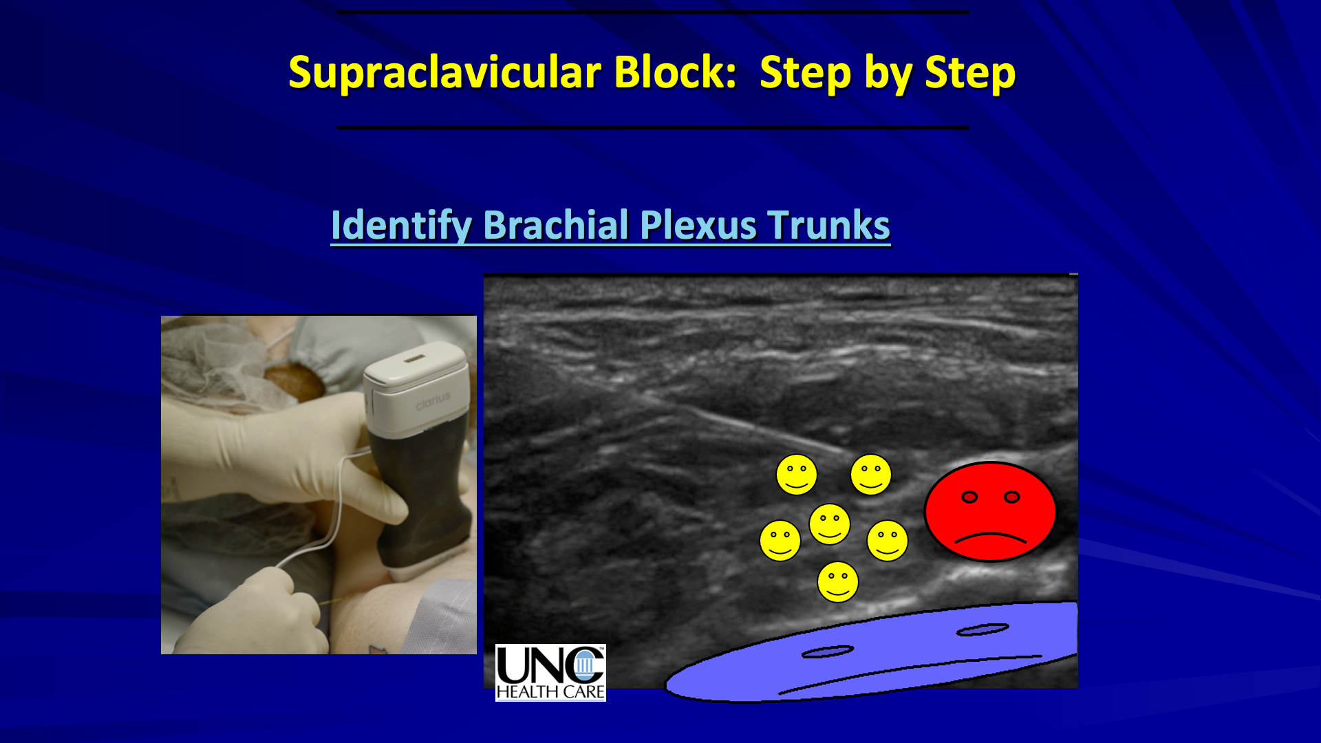 Us Guided Supraclavicular Brachial Plexus Block Inject As You Go | My ...