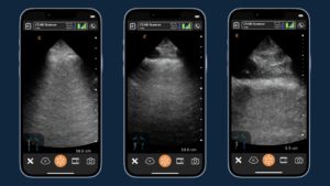 Diagnosing Lung Complications Due to COVID-19 Using Handheld Ultrasound