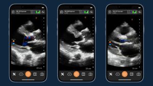 Using Handheld Ultrasound to Diagnose Cardiac Complications in a Female