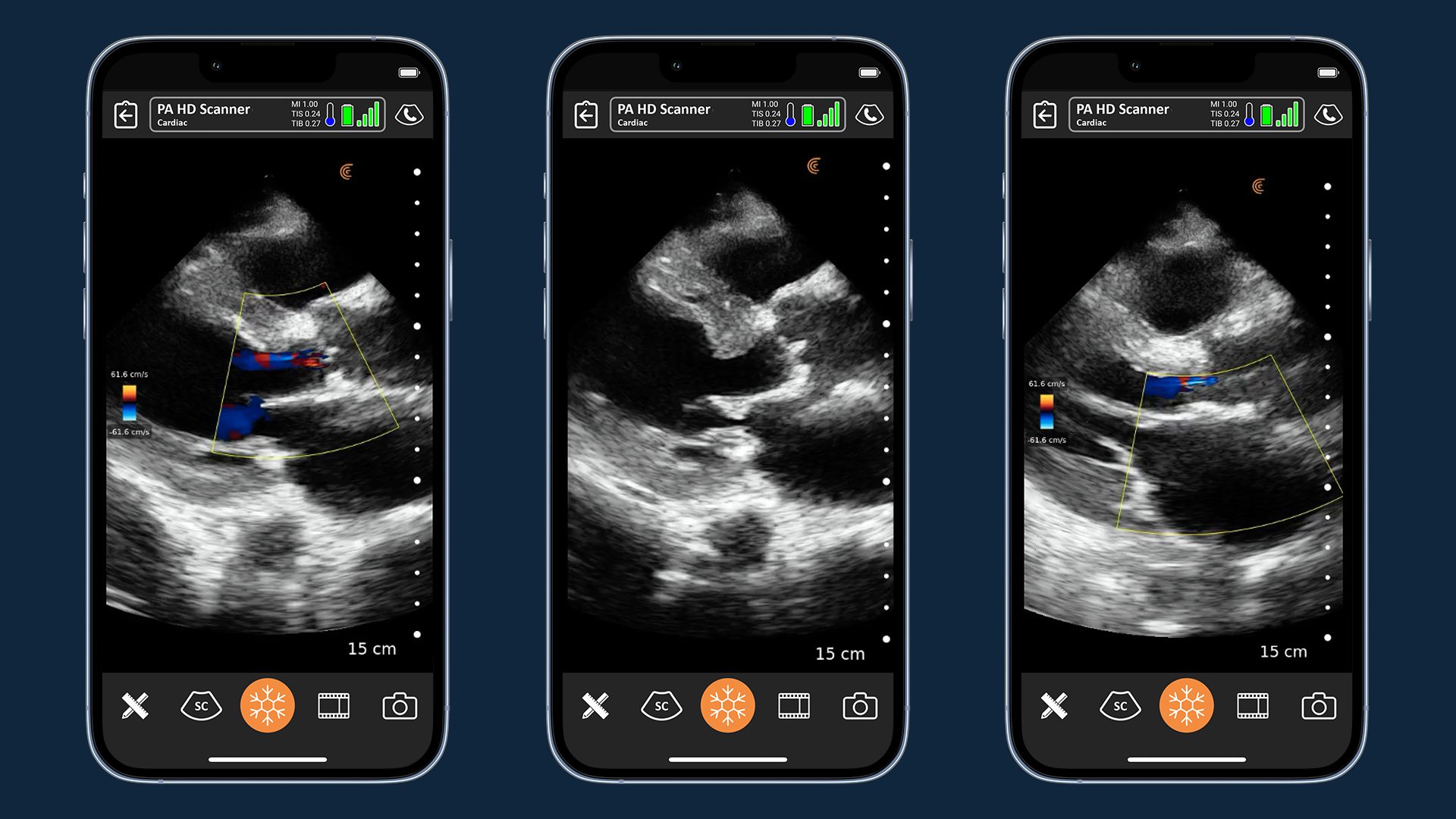 Using Handheld Ultrasound to Diagnose Cardiac Complications in a Female