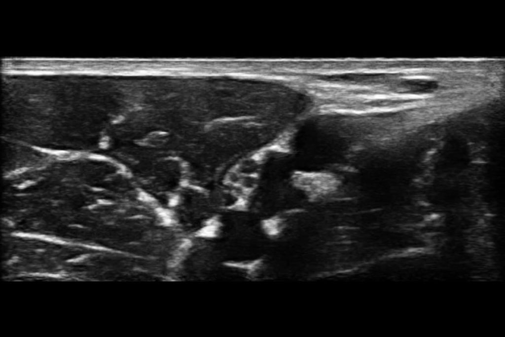 Axillary Brachial Plexus