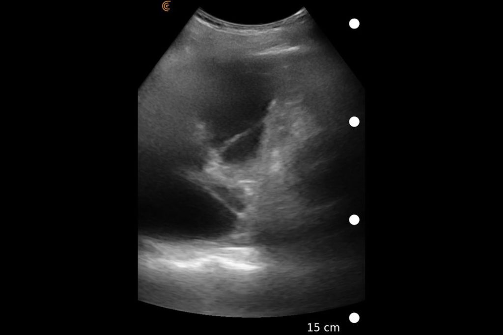 Fibrotic Pleural Effusion