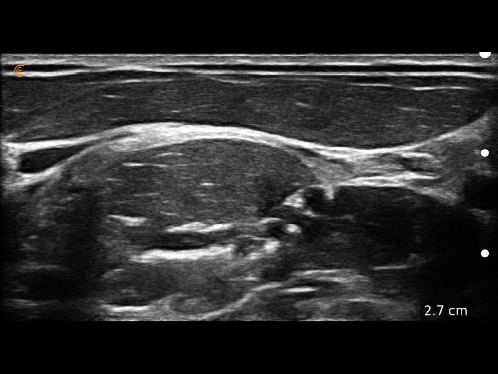 Interscalene Brachial Plexus