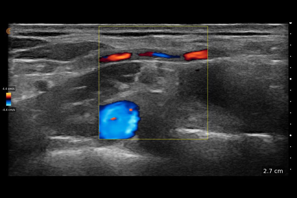 Supraclav Brachial Plexus