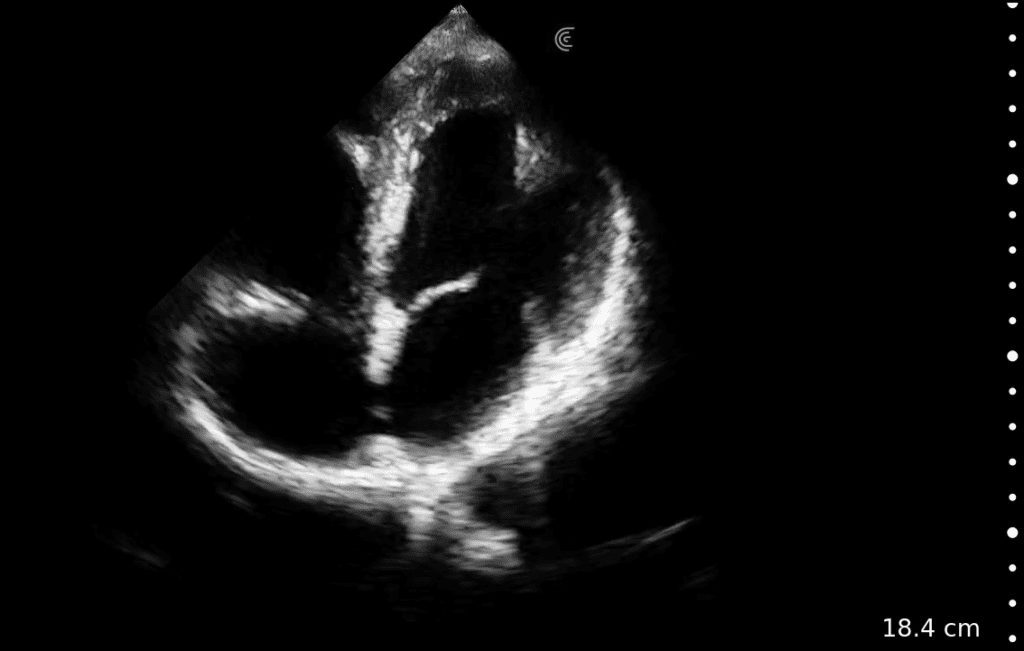 BW 4 chamber clinical image