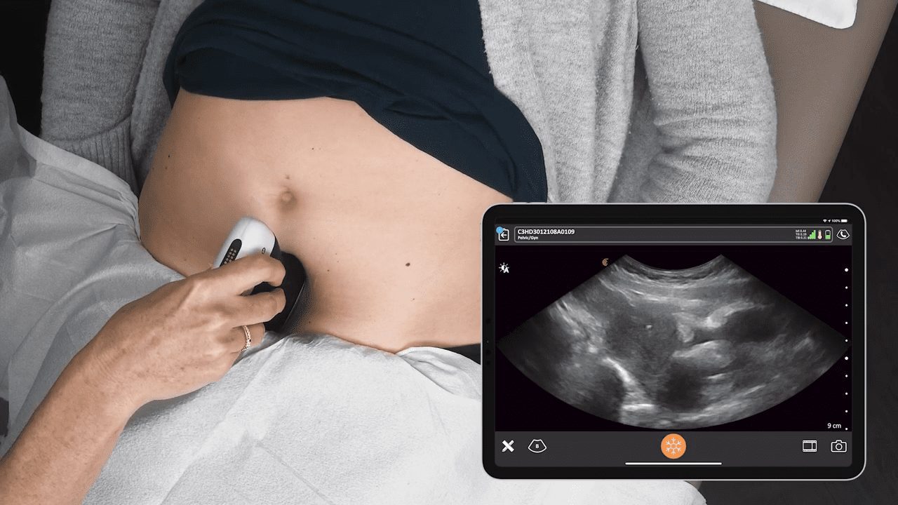 Pelvic Ultrasound IUD Clarius