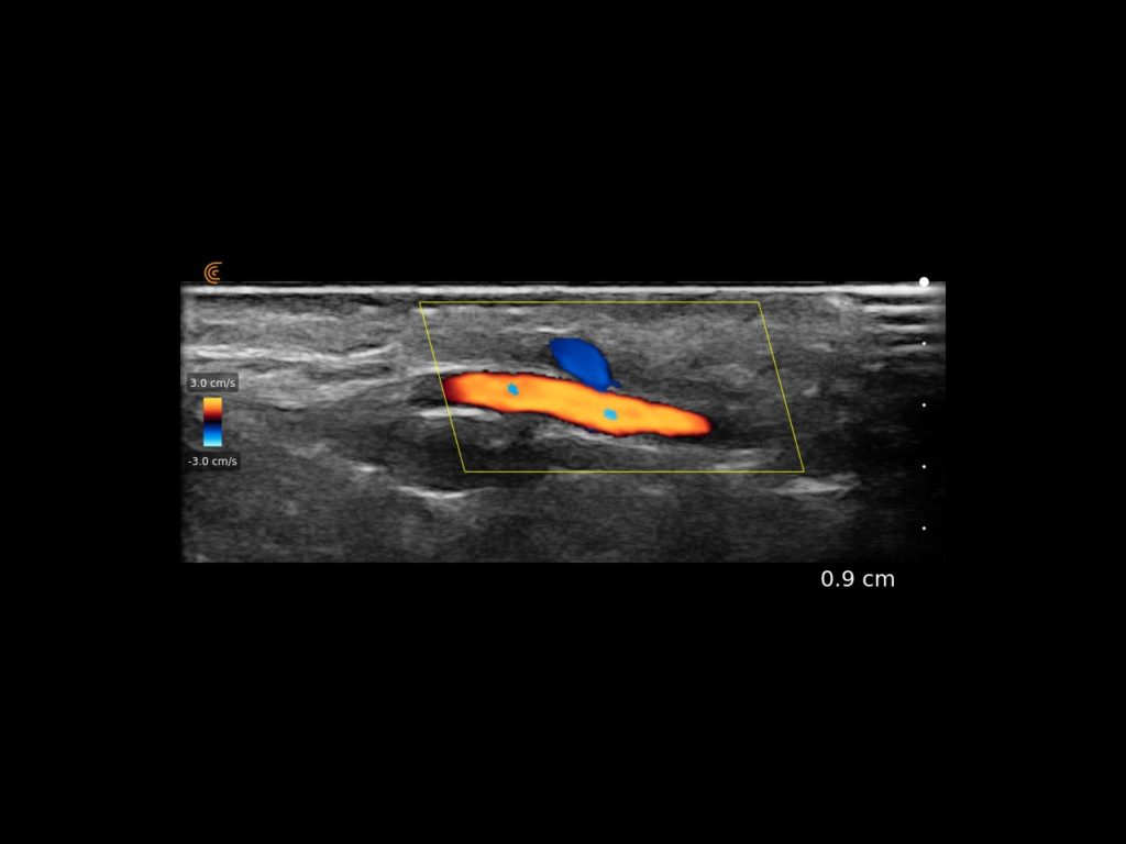 temporal artery