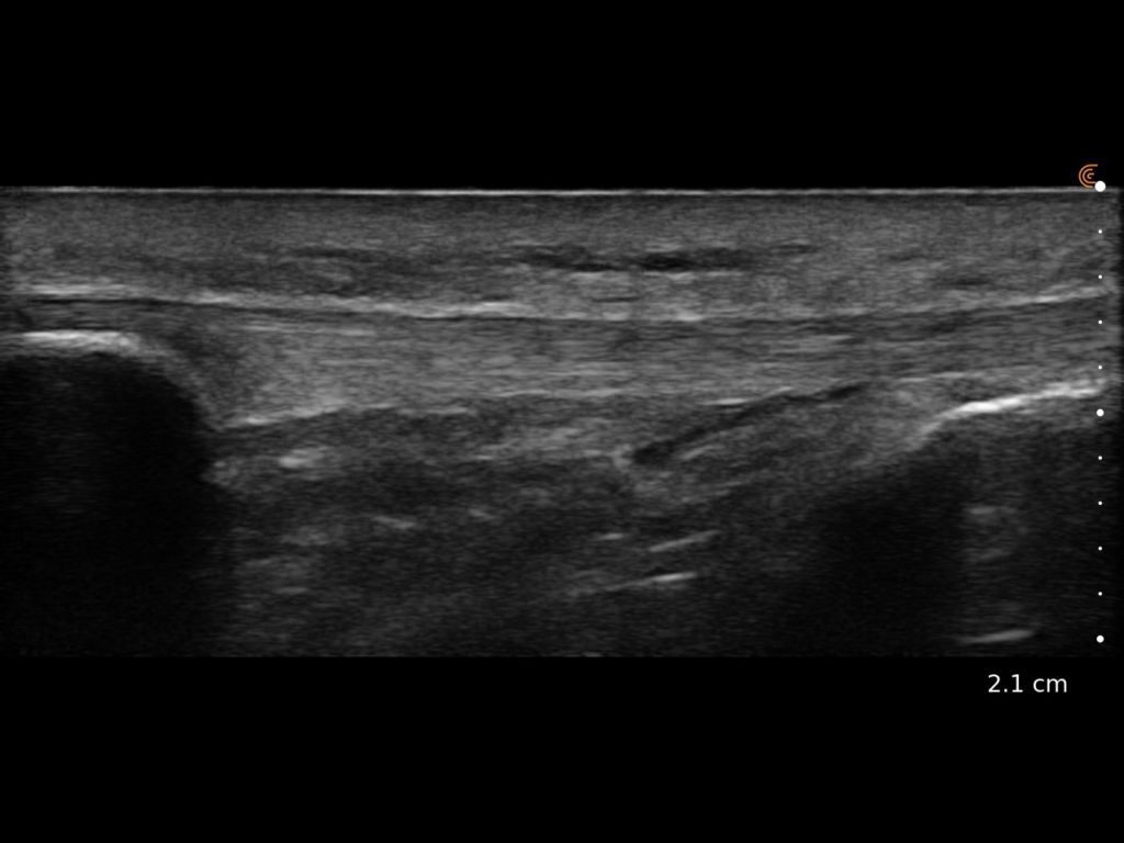 Patellar Tendon Insert
