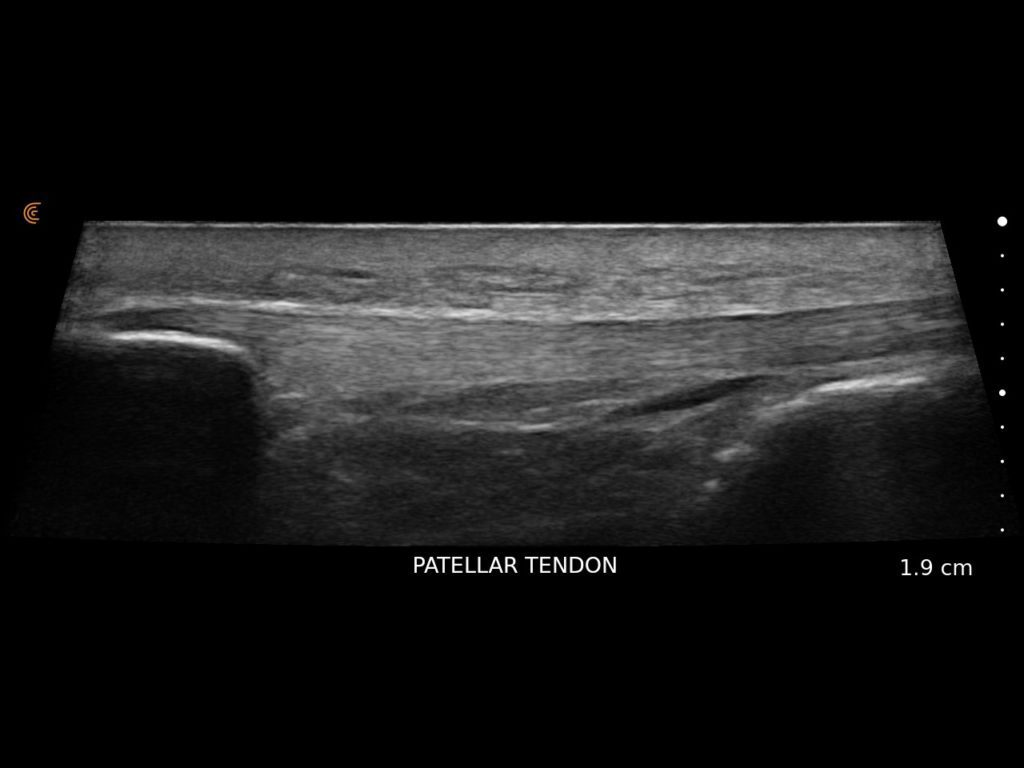 Patellar Tendon w Trapezpoid 3