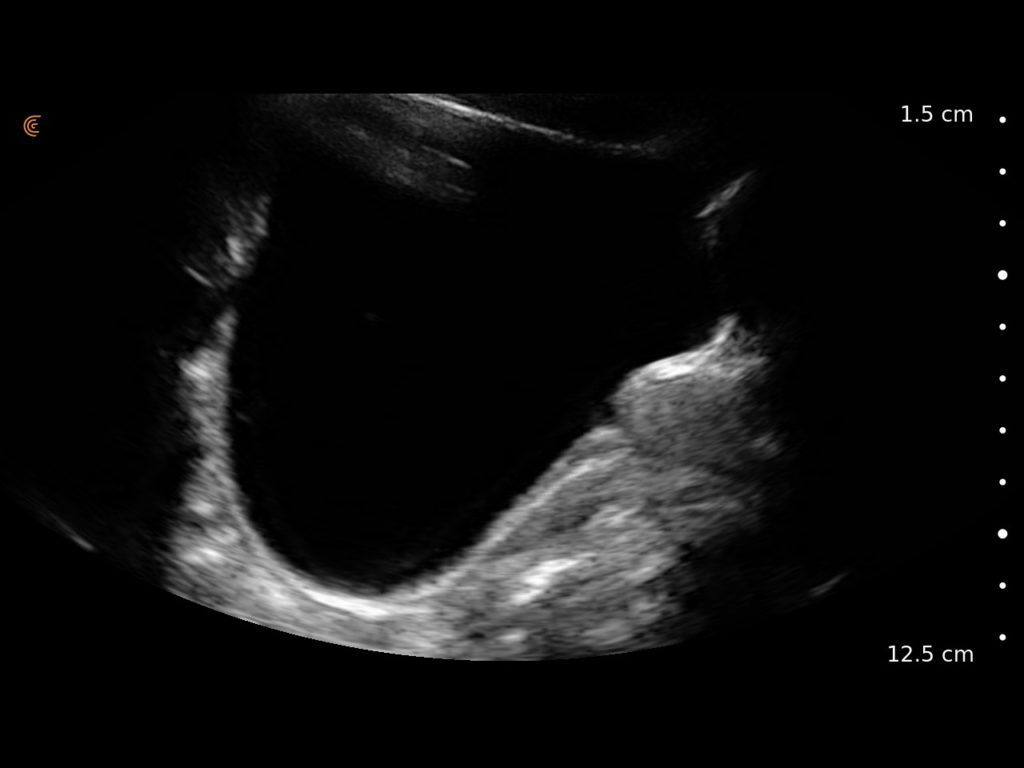 Sag Bladder Prostate