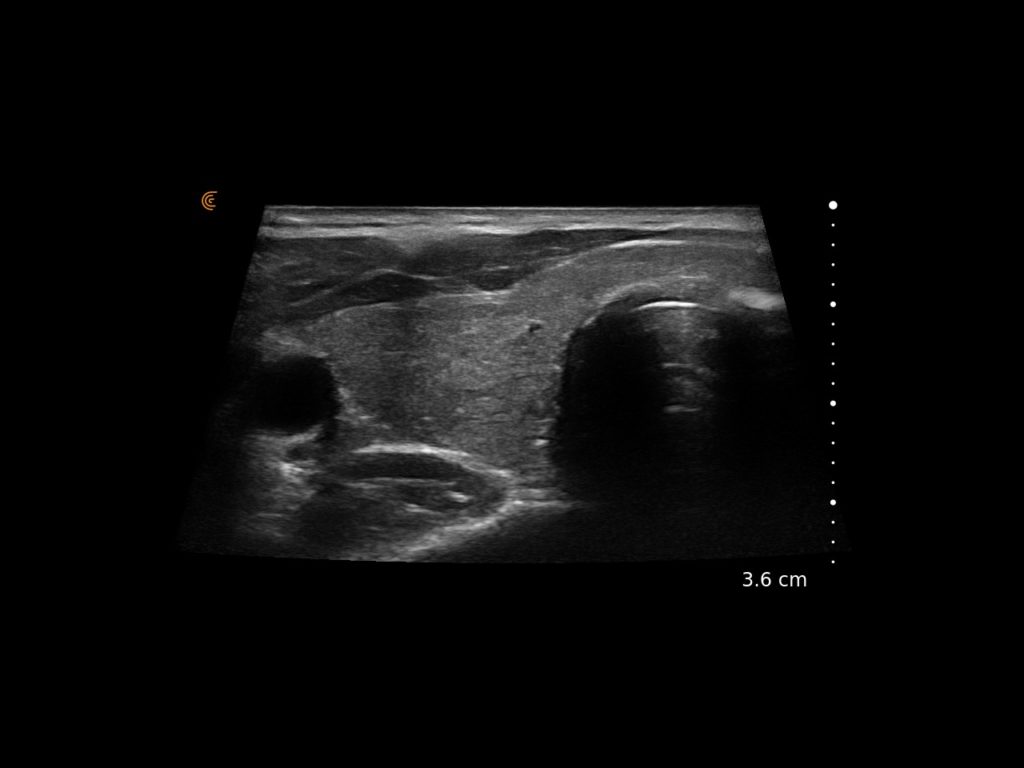 Thyroid Rt Lobe w Trapezoid