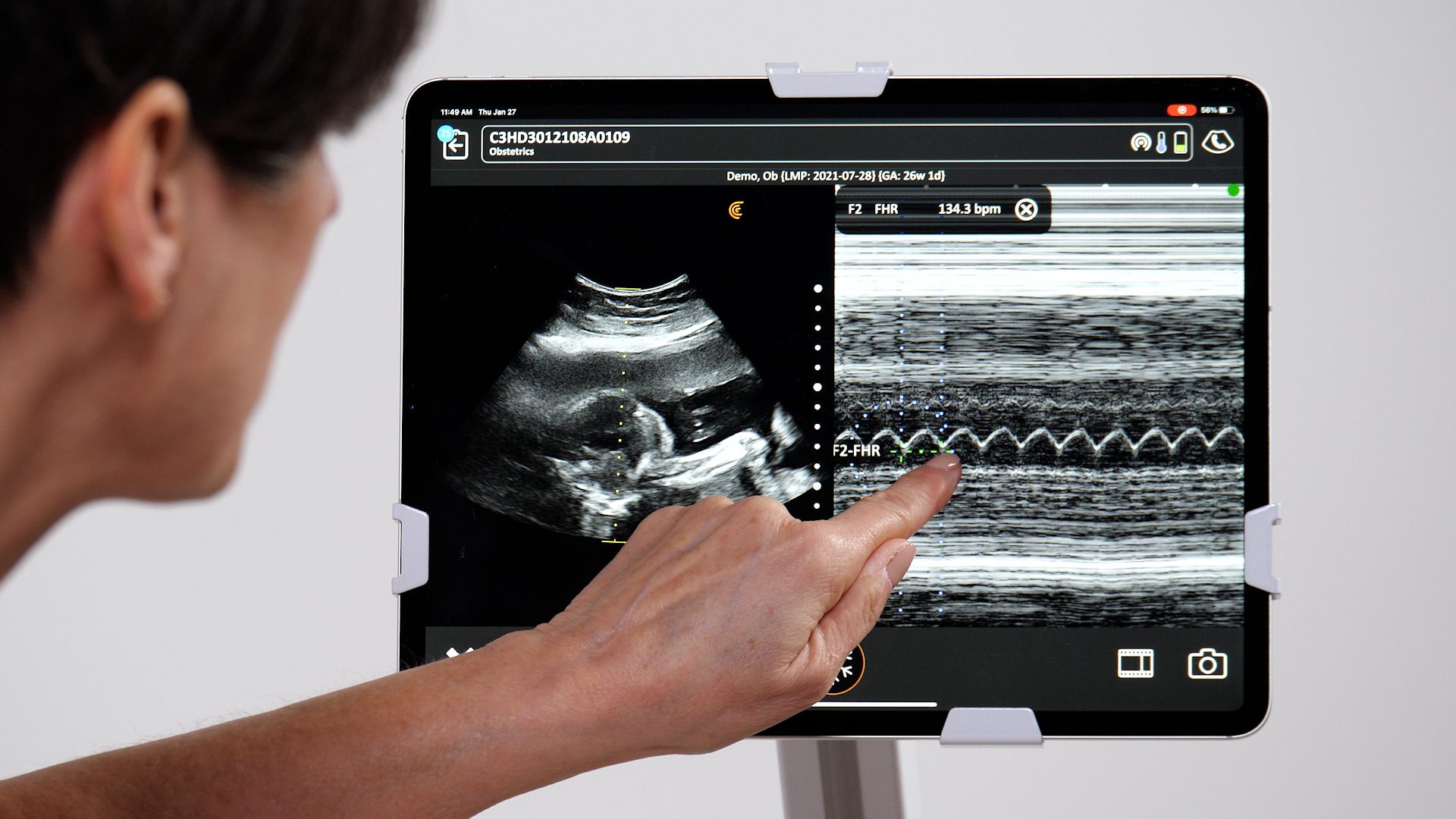 Fetal Heart M-mode | Clarius