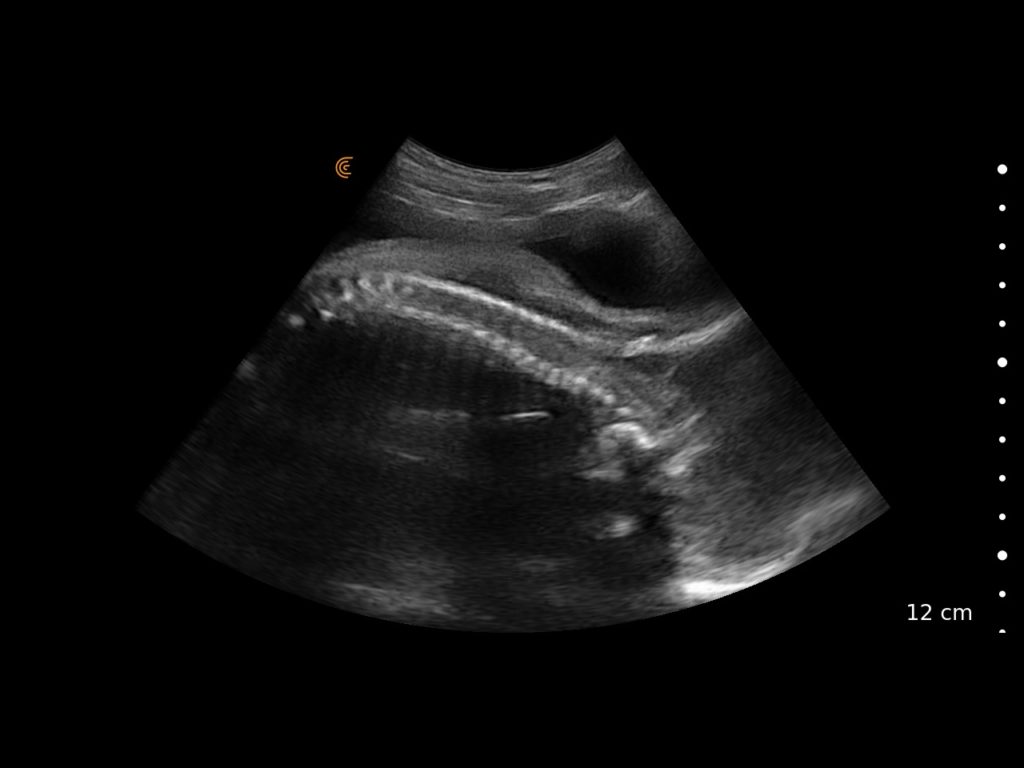 OB_Fetal CSpine_C3_HD3_Tablet