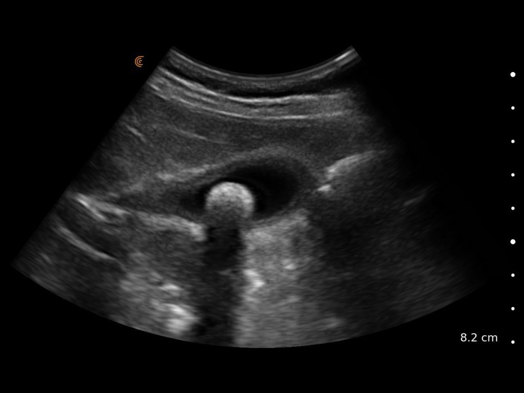 Ultrasound image showing a gallbladder stone with posterior shadowing for emergency medicine education