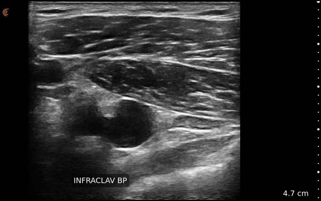 Anesth_Pain_Nerve_Infraclavicular Plexus_L15_Tablet.jpeg