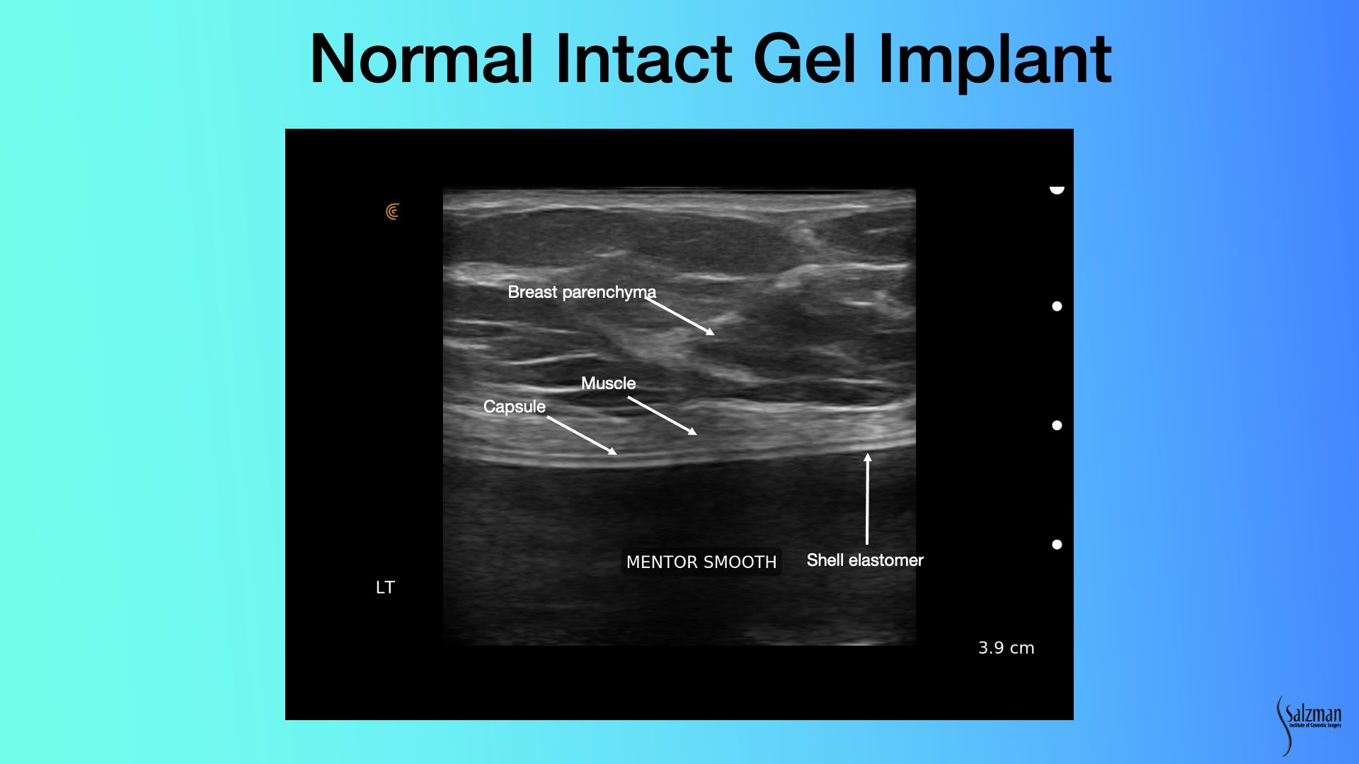 [WEBINAR] Ultrasound Essentials for Breast Plastic Surgery Visualizing