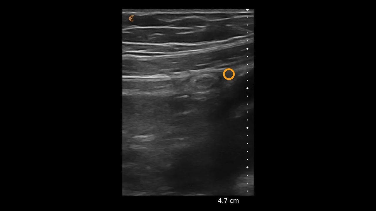 appendicitis-clarius