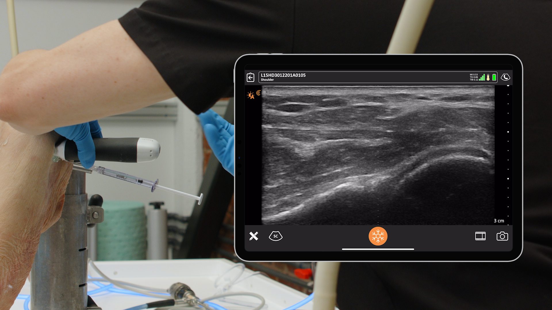 Glenohumeral Joint Injection 