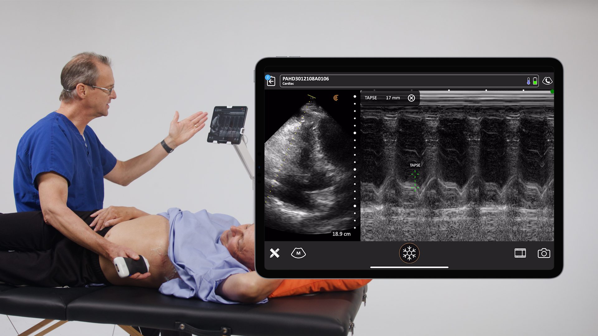 How to Measure TAPSE Clarius