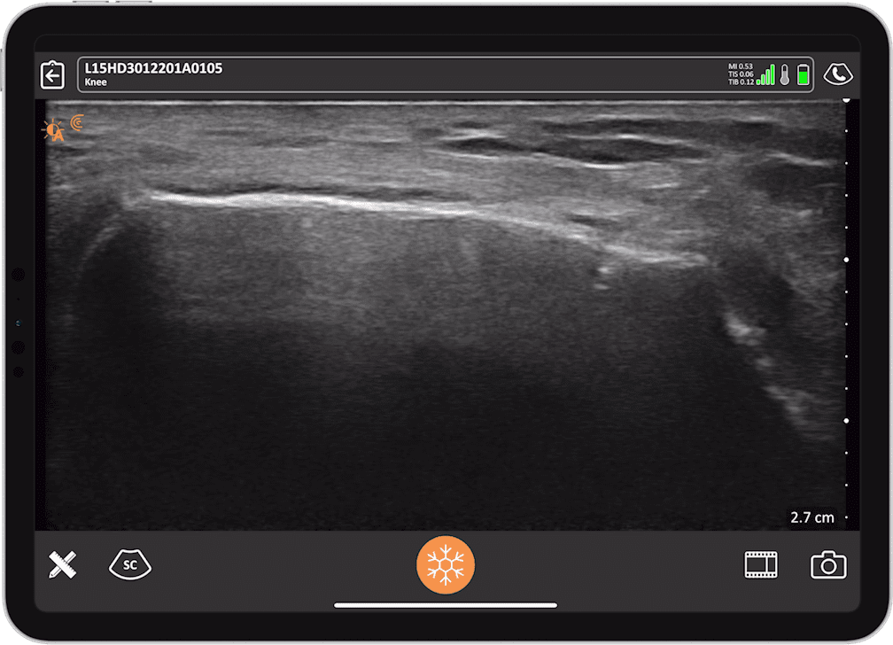 Ultrasound For Accurate Msk Injections And Interventions, Part 2: The 