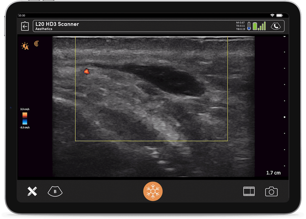 Ultrasound-Guided Techniques to Rapidly Dissolve Fillers, Part 1 ...