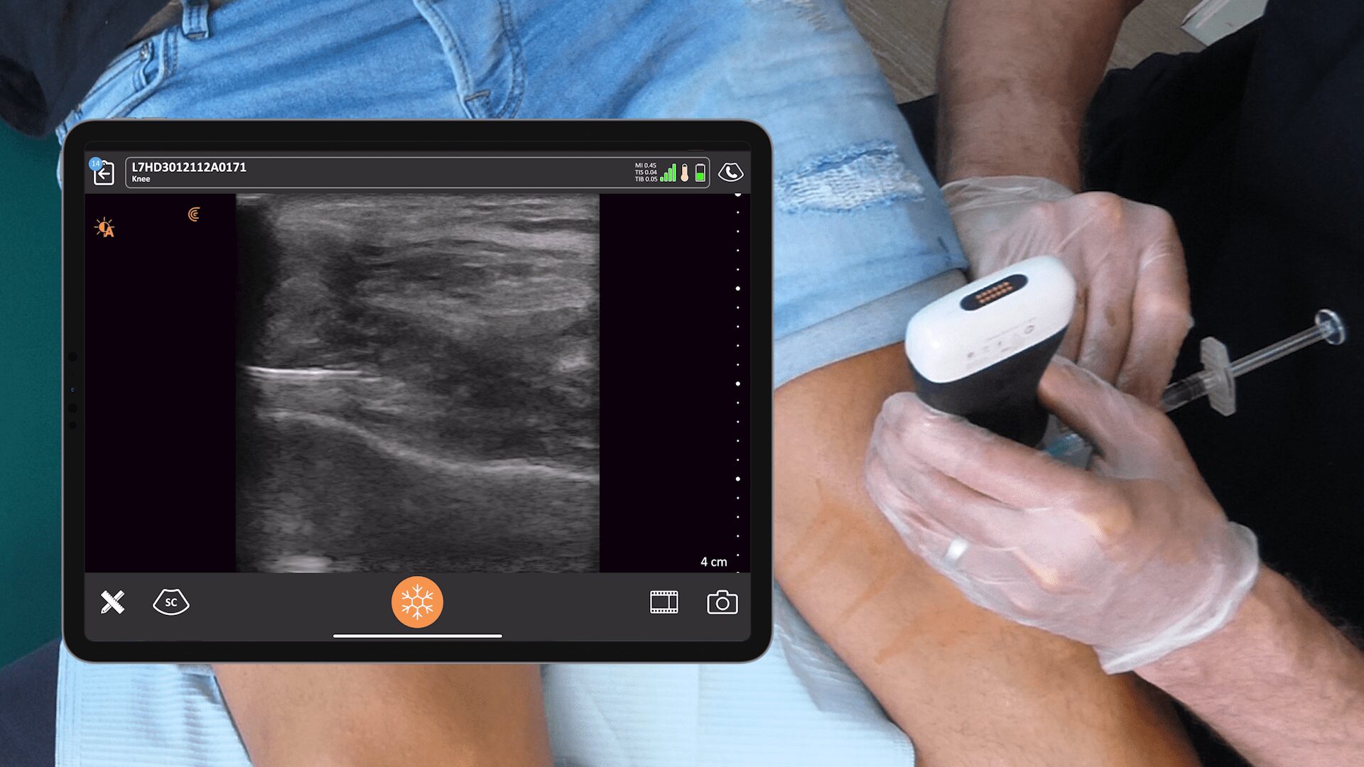 Hyaluronic Acid Knee Injection | Clarius