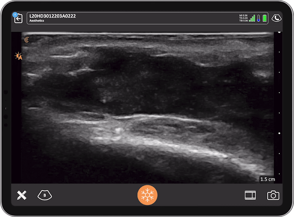 Ultrasound-Guided Treatment for Extreme Aesthetic Complications: Part 2 ...