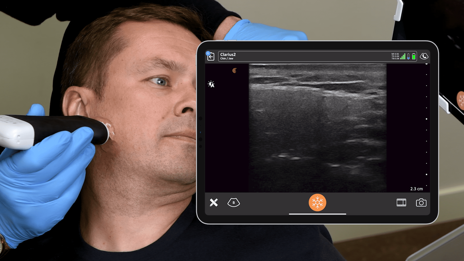 Ultrasound of the Male Jawline Clarius