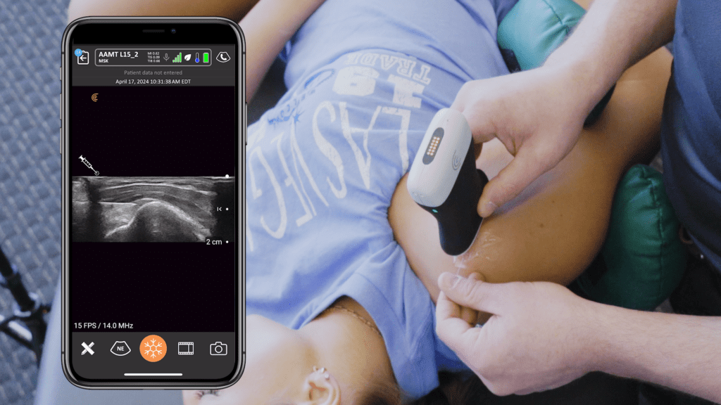 Ultrasound Guided Dry Needling Enhancing Precision And Outcomes Clarius