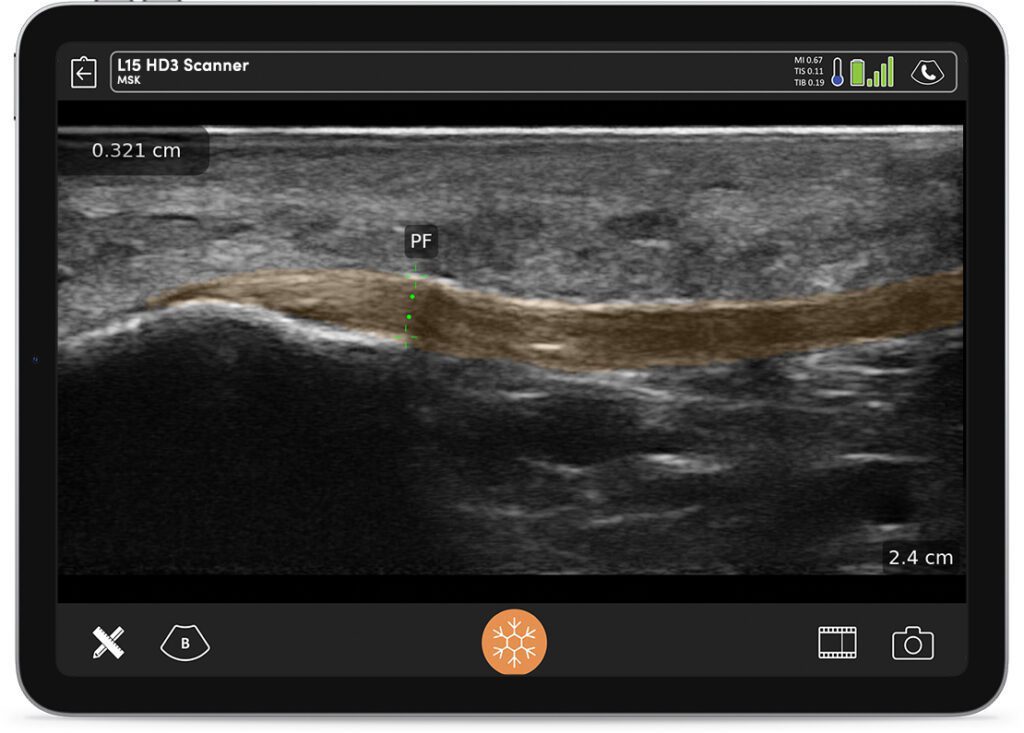 The Clarius HD3, a cutting-edge wireless handheld ultrasound, features powerful MSK AI technology that enhances musculoskeletal imaging—making it easier than ever to perform accurate point-of-care ultrasound (POCUS) with this portable ultrasound scanner.