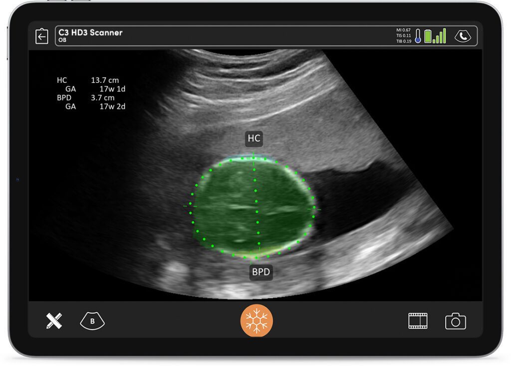 With Clarius ultrasound, clinicians can make faster diagnoses at the bedside.
