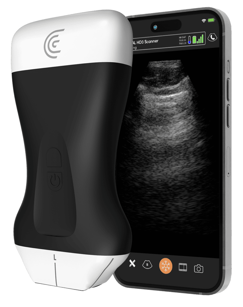 Wireless Ultrasound