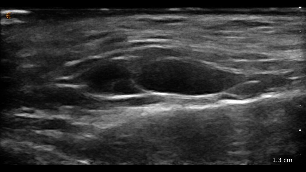 Ultrasound image of cheek filler placement showing tissue layers for precision in aesthetic injections.
