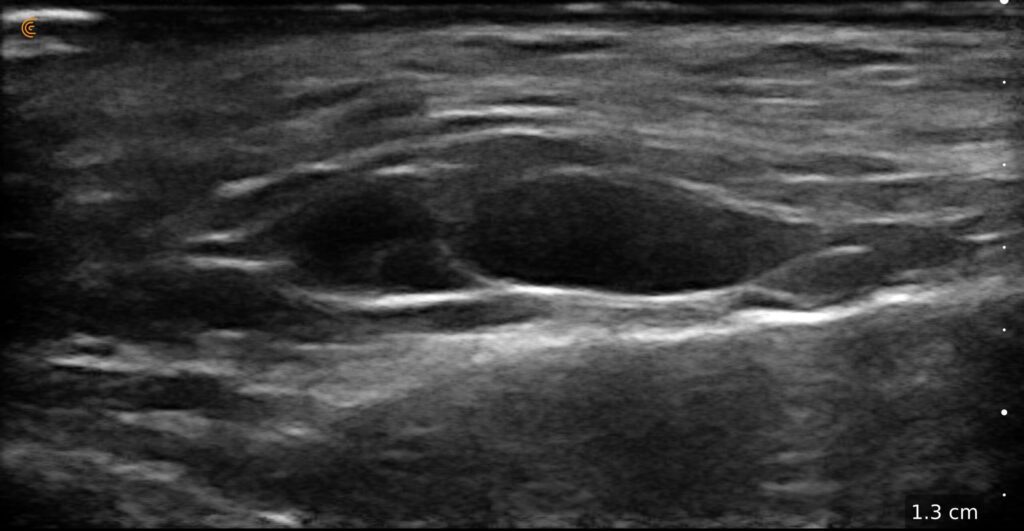 Ultrasound image of cheek filler placement showing tissue layers for precision in aesthetic injections.