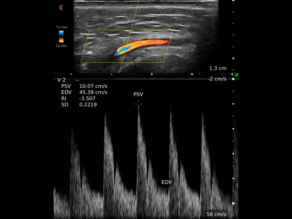 Ultrasound image of facial artery with pulsed wave Doppler for aesthetic injectors
