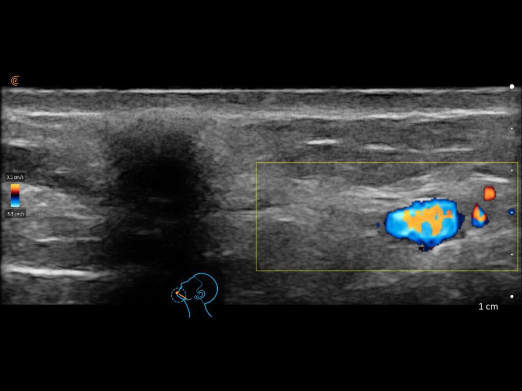 Ultrasound image showing PMMA filler with facial artery visualization to guide safe aesthetic injections.